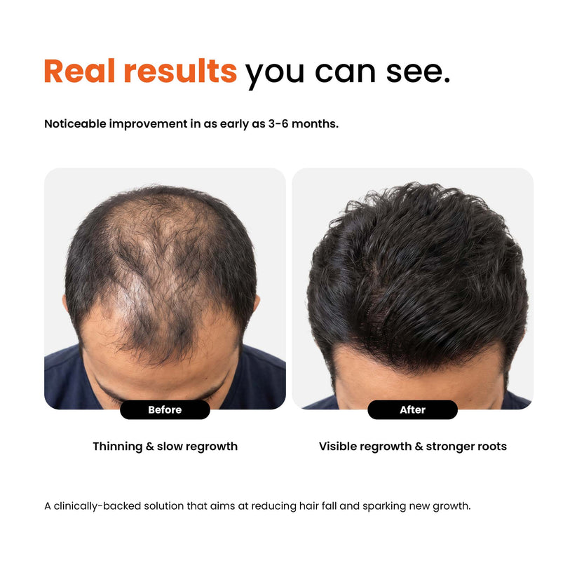 Hair Growth Topical Solution and Vitamin Supplements | Scientifically Tested | Vegan Friendly
